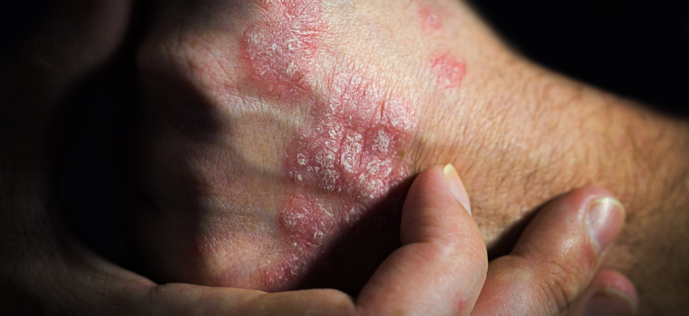 Psoriasis: Calming Symptoms with CBD