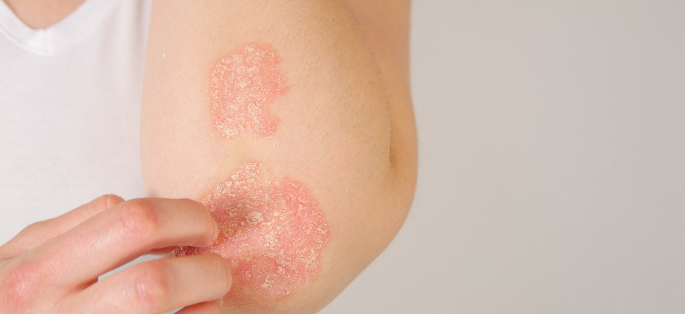 Psoriasis: Easing the Symptoms With CBD